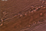 Arterial Scierosis